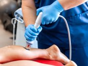 Understanding Shockwave Therapy and Its Use Cases