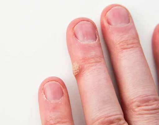Different Types of Warts (With Pictures) and How to Treat Each One
